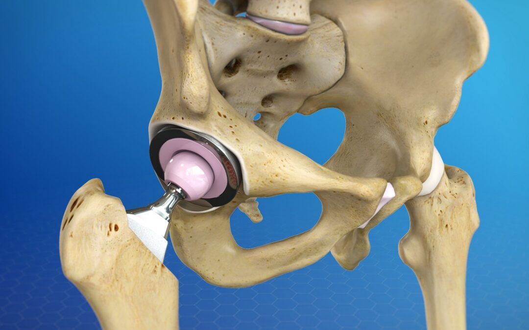 Total Hip Replacement and Why An Anterior Approach Might Be Your Best Option