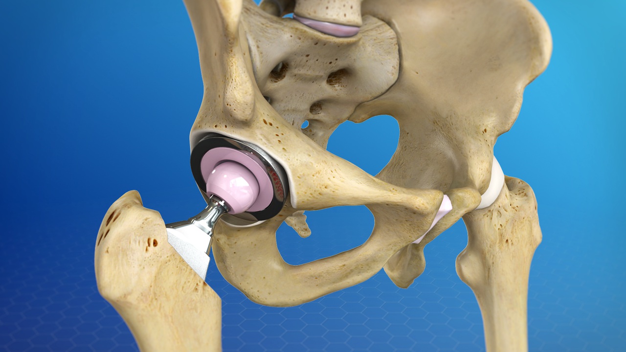 Total Hip Replacement and Why An Anterior Approach Might Be Your Best Option